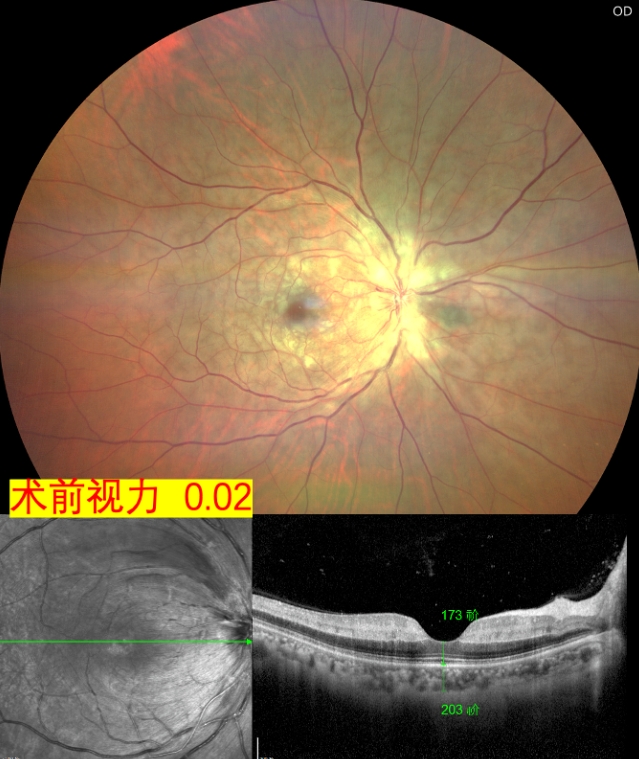 視網(wǎng)膜中央動(dòng)脈阻塞