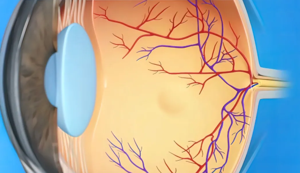 糖尿病視網膜病變